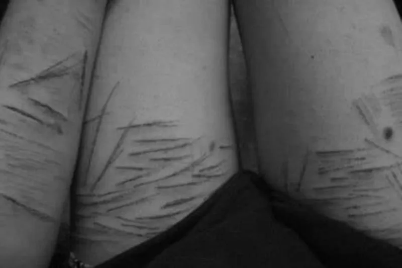 Moralne dylematy samookaleczania